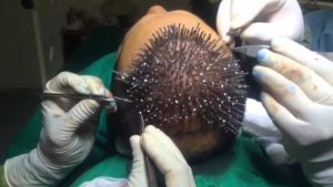 implante pelo