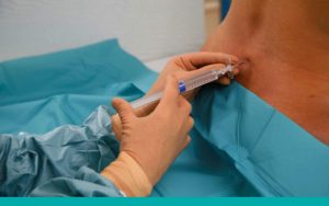 epidural