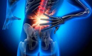 hernia discal