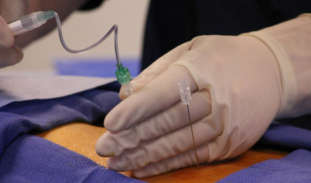 Epidural anesthesia