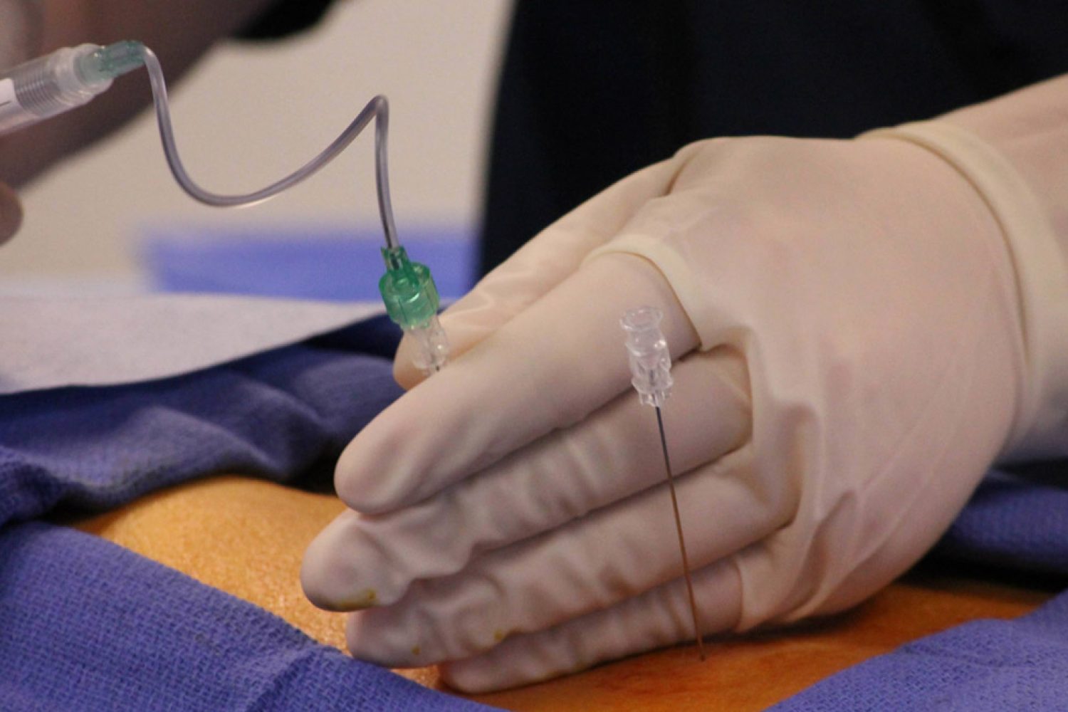 Epidural-anesthesia