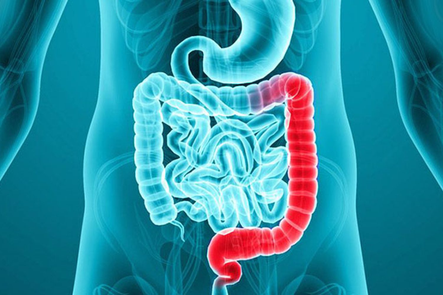 colitis ulcerosa