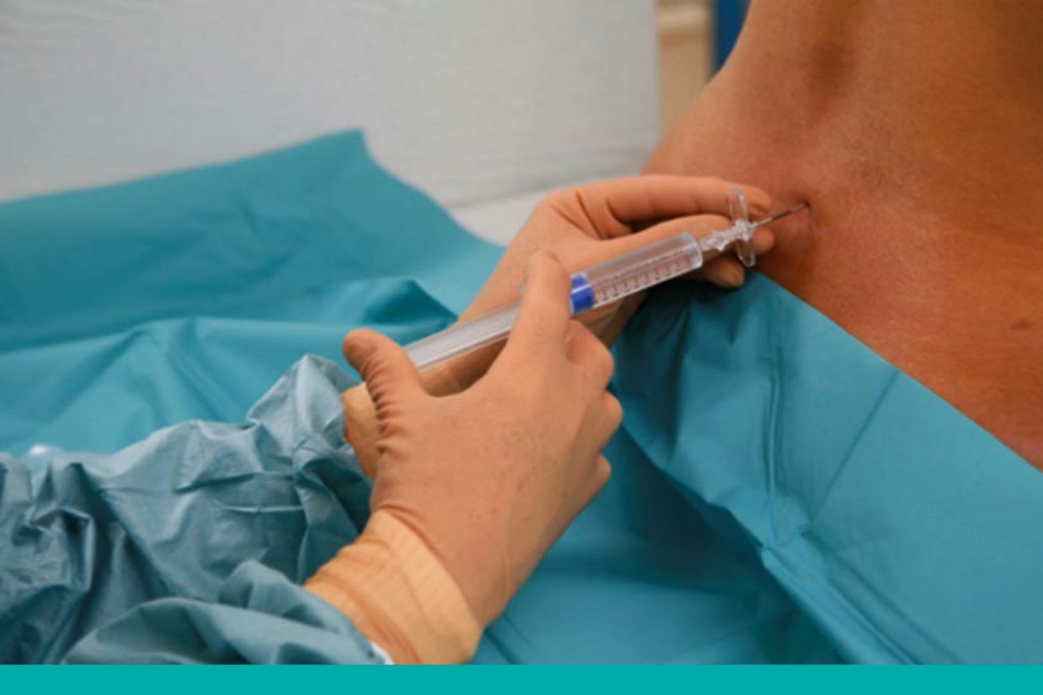 epidural
