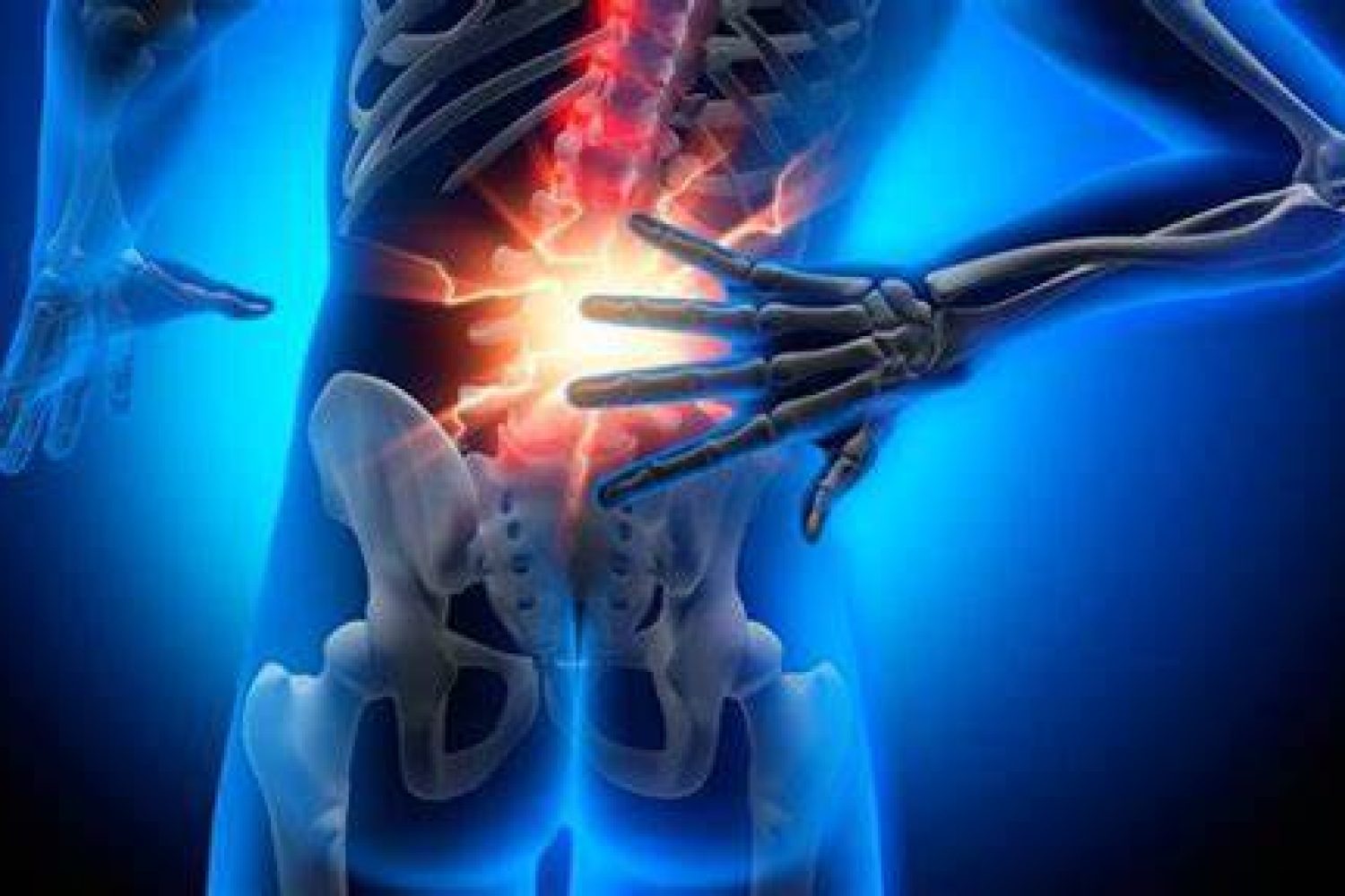 hernia discal