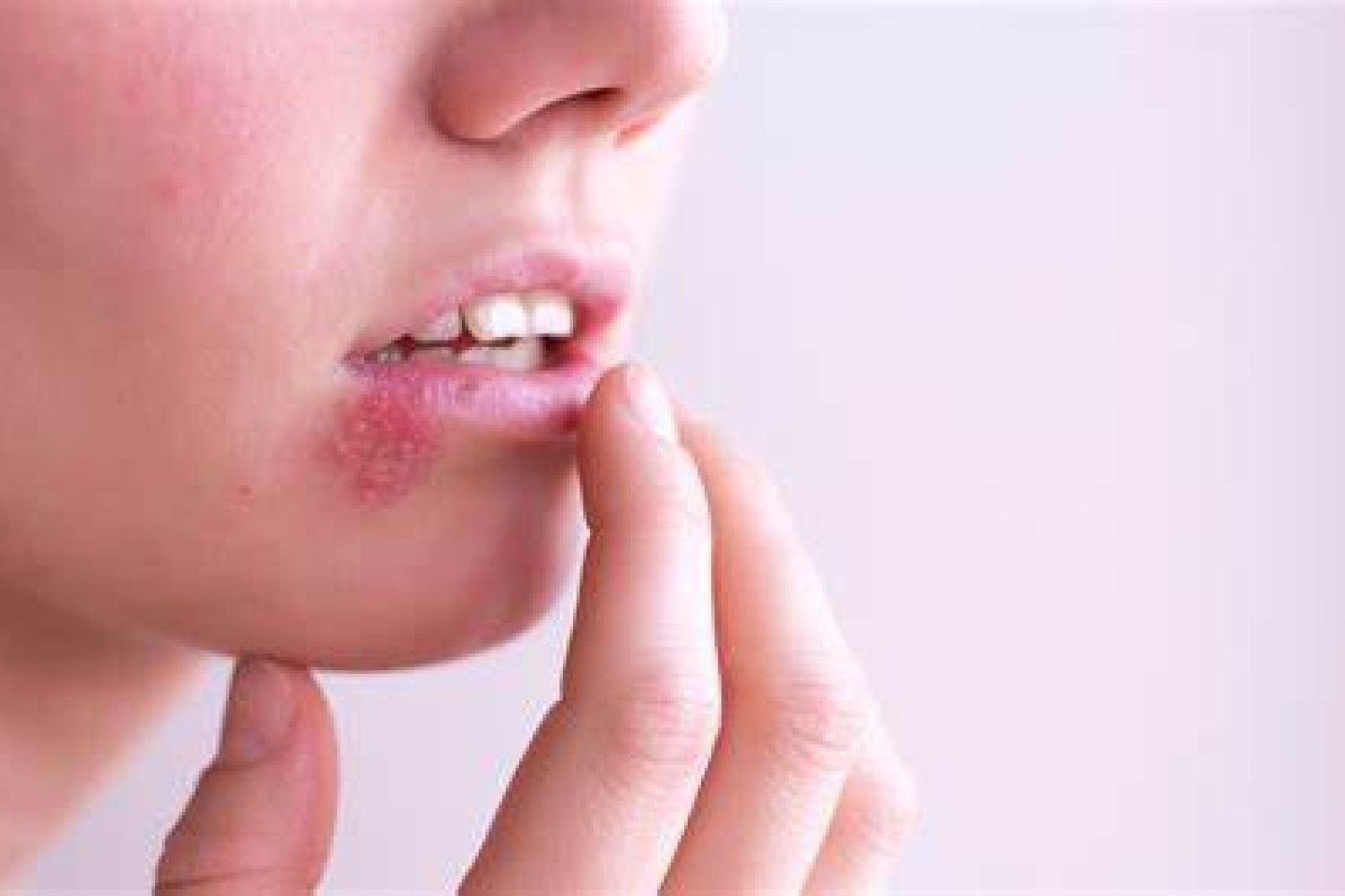 herpes labial
