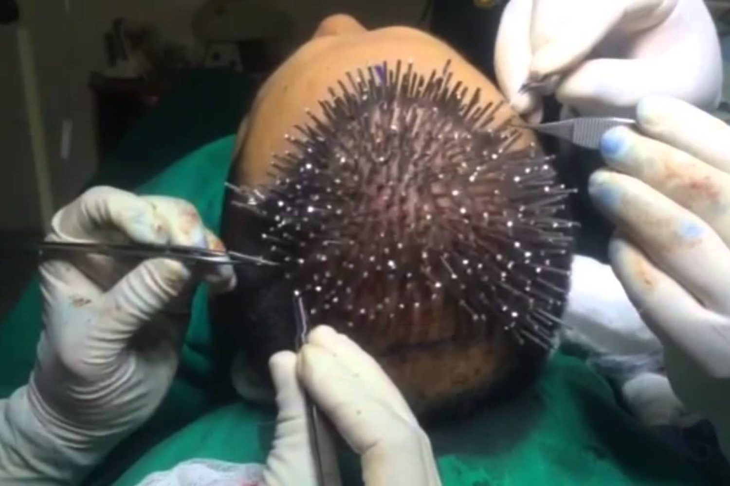 implante pelo