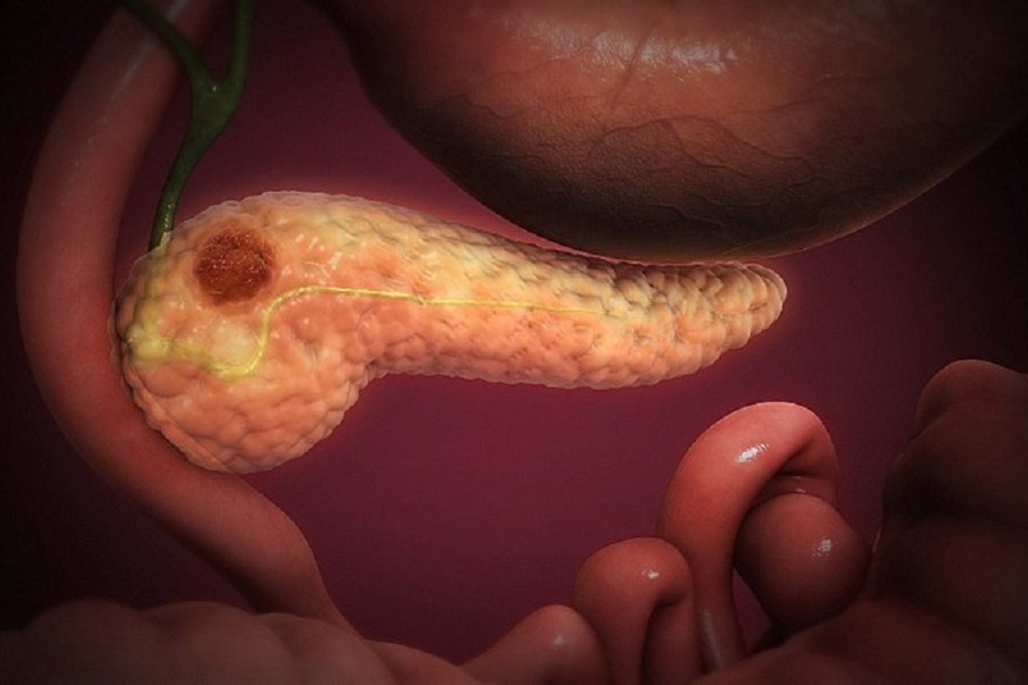 pancreatitis