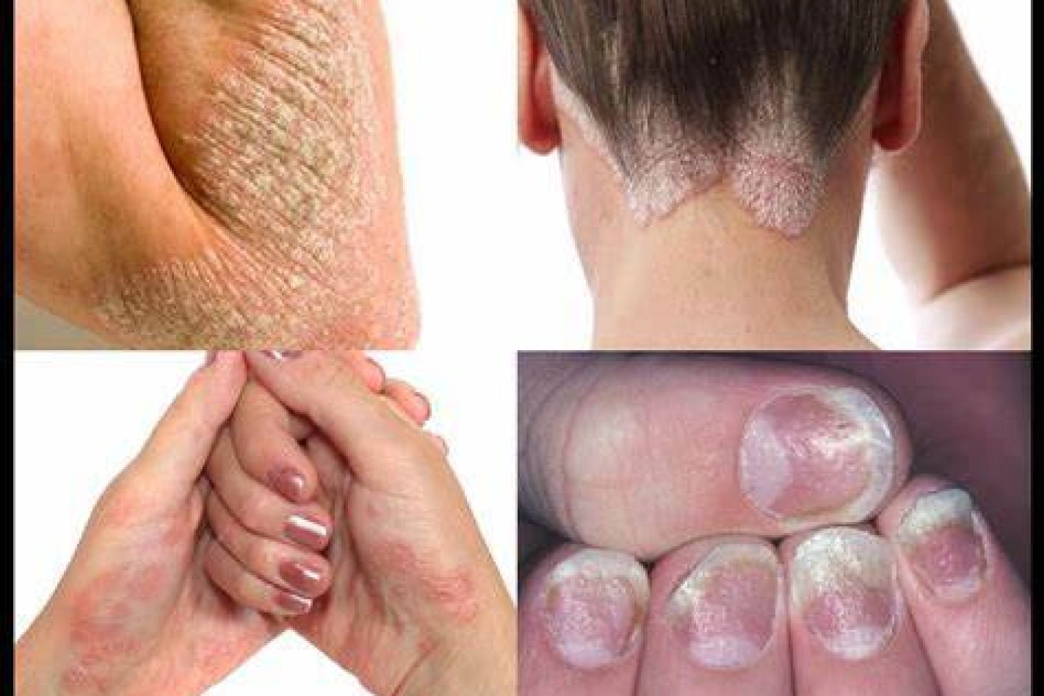 psoriasis