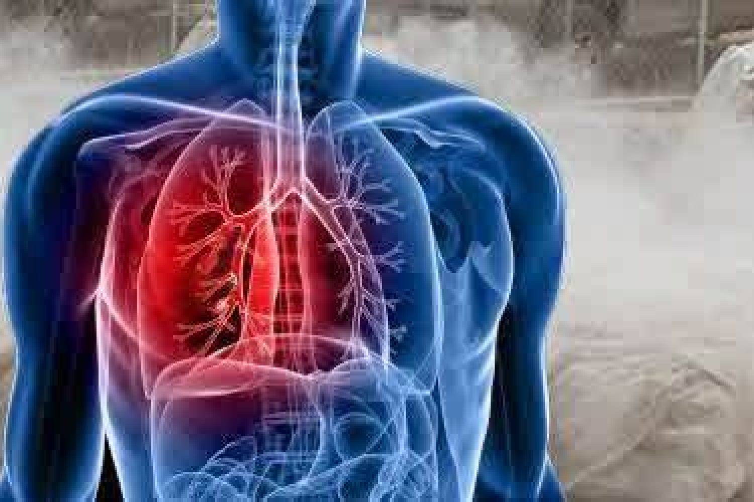 silicosis