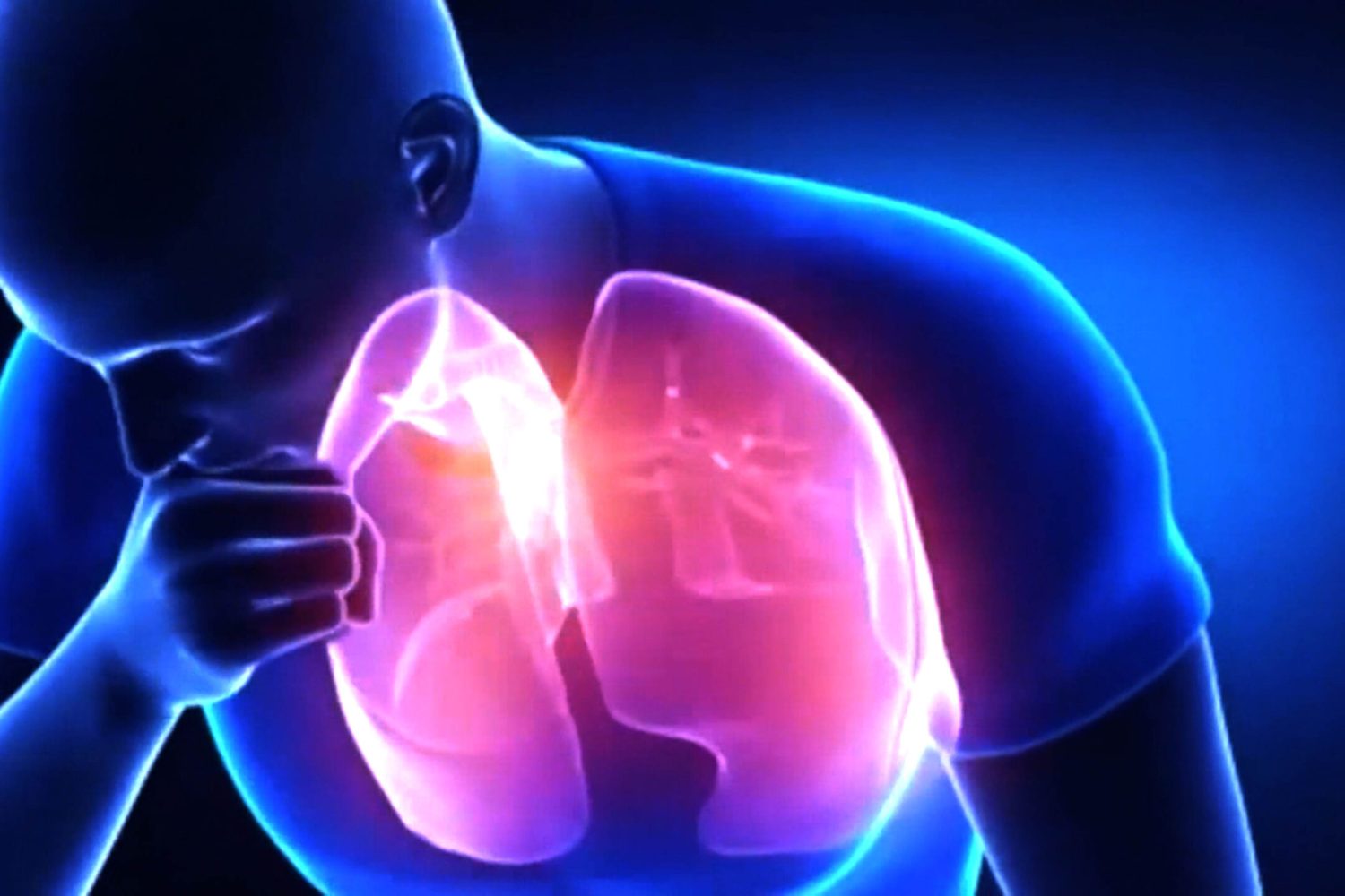 tuberculosis